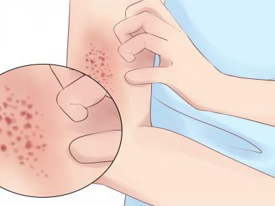 夏天床上有紅色的小蟲怎么辦 紅色小蟲的應(yīng)對措施