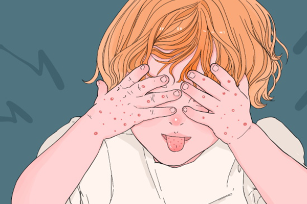 絲蟲病分類有哪些?