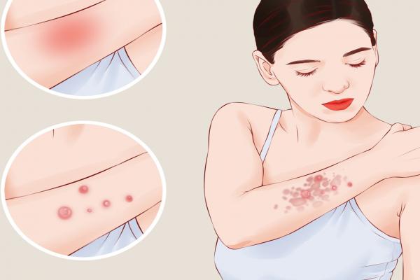 水痘能不能吃荷蘭豆