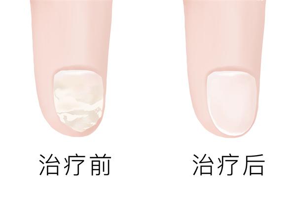 治療灰指甲哪家醫院好