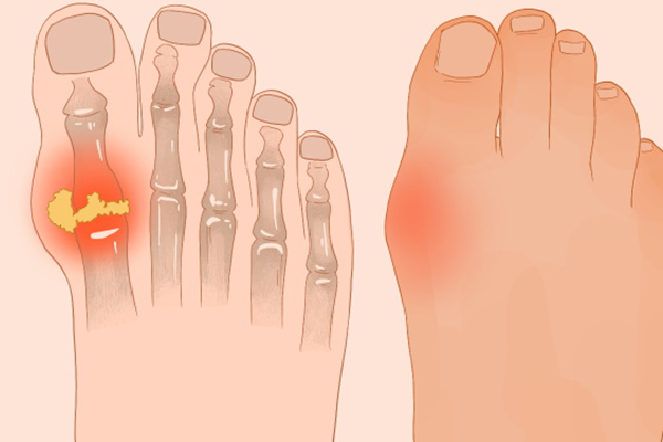 痛風能不能吃牛蛙