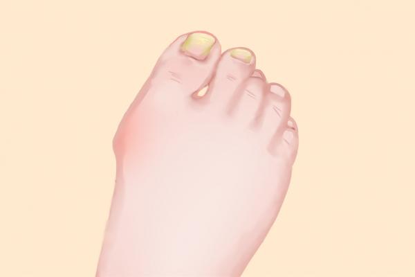 治療灰指甲哪家醫院好