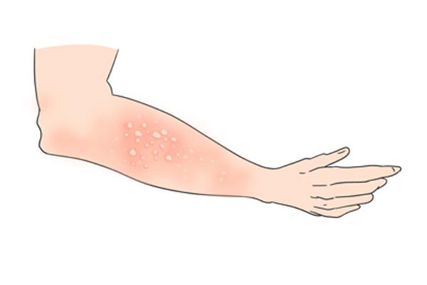 得了蕁麻疹不能吃什么食物