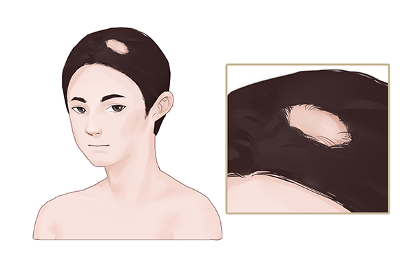 脫發(fā)是腎虛嗎-易網(wǎng)健康<a href=http://m.henggaotouzi.com/jkys/ target=_blank class=infotextkey>養(yǎng)生</a>網(wǎng) 脫發(fā)是腎虛嗎