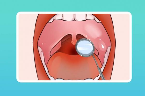 扁桃體炎是什么癥狀