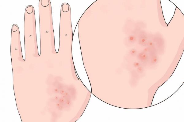 水痘能不能吃荷蘭豆