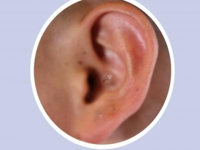 耳朵后面突然鼓起一個硬包