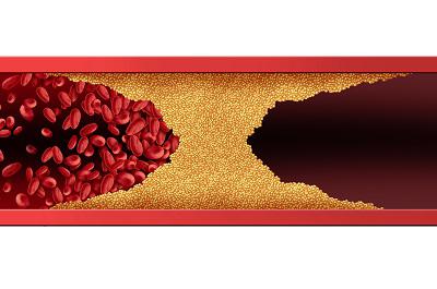 血管堵了自己有感覺嗎 血液病的三大預(yù)警信號-易網(wǎng)健康<a href=http://m.henggaotouzi.com/jkys/ target=_blank class=infotextkey>養(yǎng)生</a>網(wǎng) 血管堵了自己有感覺嗎 血液病的三大預(yù)警信號