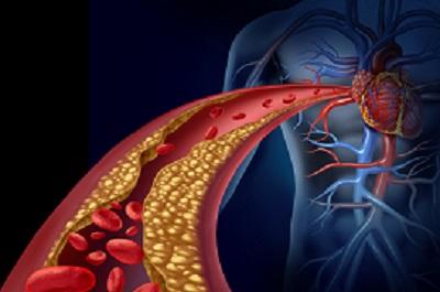 怎么知道自己血脂稠了 這些指標異常證明血脂稠了