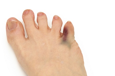 怎么判斷是不是糖尿病足 糖尿病足4大顯著表現