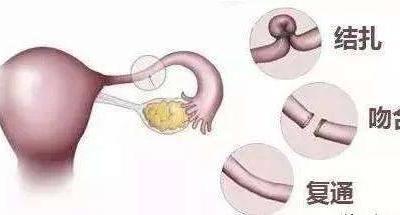 女性結扎會不會影響夫妻性生活，到底結扎對女人有什么危害