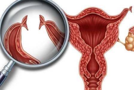 二胎剖腹產后做結扎手術 結扎對女性身體影響有多大