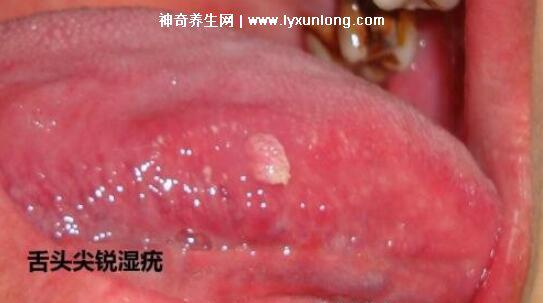 男性早期圖片尖濕銳疣長在哪，生zhi器甚至是口腔(菜花狀疣體出血)