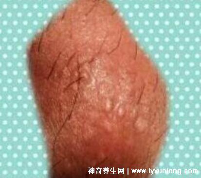 初期尖銳濕尤圖癥狀圖片男性，淡紅色小疙瘩變大為菜花狀疣體
