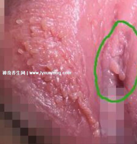 女性假疣和真疣的圖片對比，前者淡紅色和淡褐色魚子狀(5大區別)