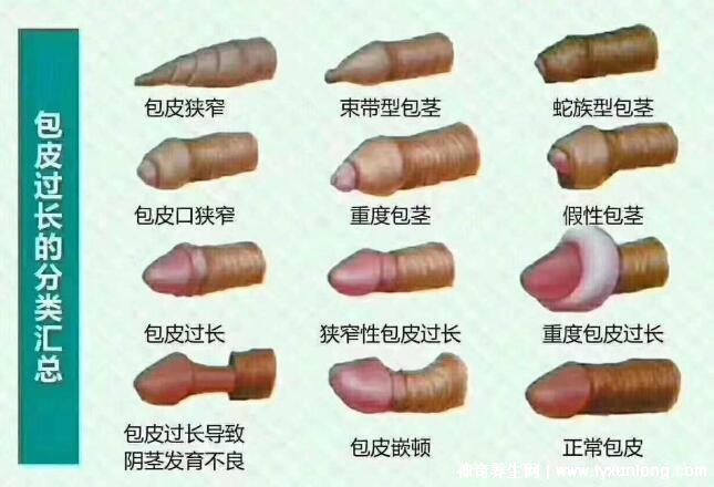 老公割包之后好像沒有那么厲害了，因為更敏感了(5個原因)