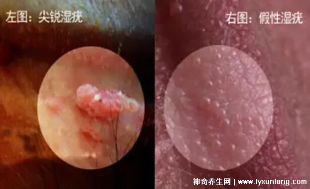 女性假疣和真疣的圖片對比，前者淡紅色和淡褐色魚子狀(5大區別)