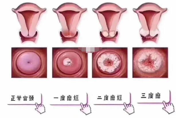 宮頸糜爛一二三度圖片，真實對比照片(小心是宮頸癌前兆)