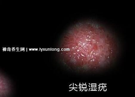 女性假疣和真疣的圖片對比，前者淡紅色和淡褐色魚子狀(5大區別)