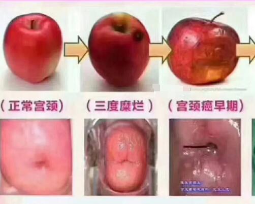 宮頸糜爛一二三度圖片，真實對比照片(小心是宮頸癌前兆)