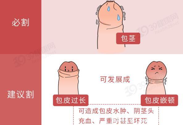 成年男子割包好處和壞處，8種情況必須割(附割包照片真實)