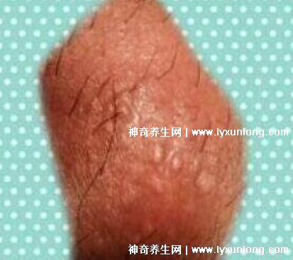 男性早期圖片尖濕銳疣長在哪，生zhi器甚至是口腔(菜花狀疣體出血)