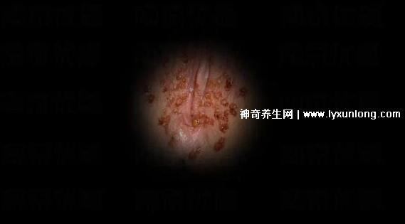 初期女士濕銳疣圖片早期，口腔尖銳濕癥狀太嚇人了(菜花樣疣體)