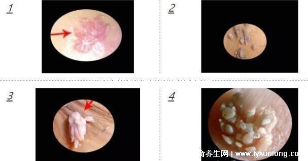男性早期圖片尖濕銳疣長在哪，生zhi器甚至是口腔(菜花狀疣體出血)