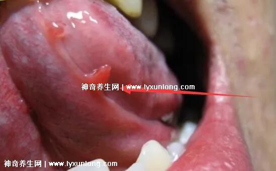 初期女士濕銳疣圖片早期，口腔尖銳濕癥狀太嚇人了(菜花樣疣體)