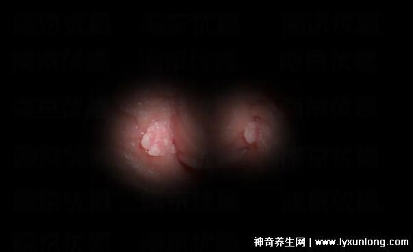 初期尖銳濕尤圖癥狀圖片男性，淡紅色小疙瘩變大為菜花狀疣體