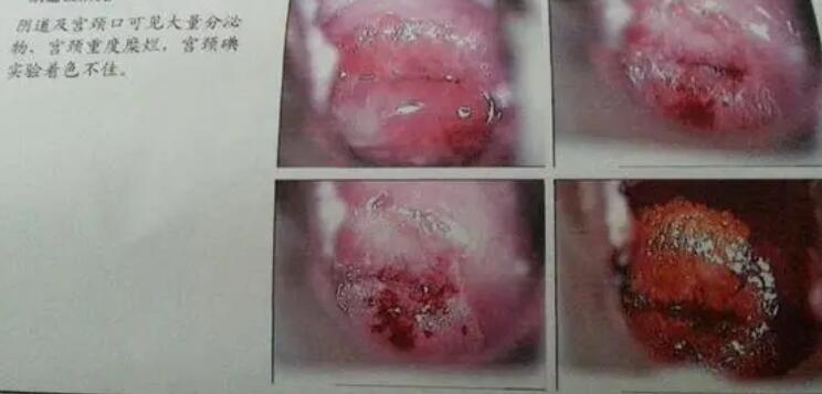 宮頸糜爛一二三度圖片，真實對比照片(小心是宮頸癌前兆)