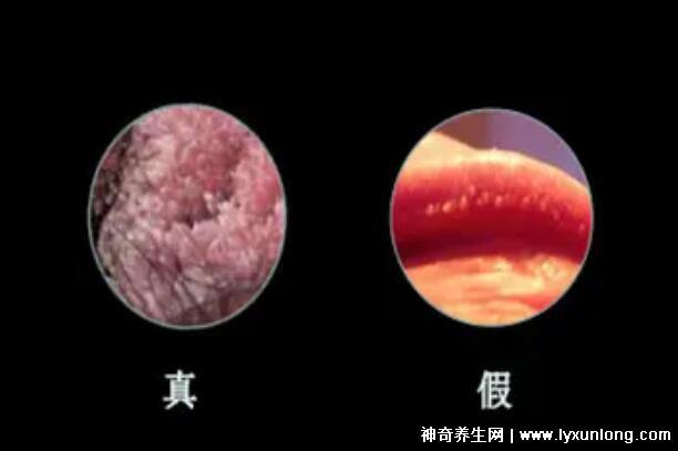 女性假疣和真疣的圖片對比，前者淡紅色和淡褐色魚子狀(5大區別)