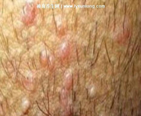 男性早期圖片尖濕銳疣長在哪，生zhi器甚至是口腔(菜花狀疣體出血)