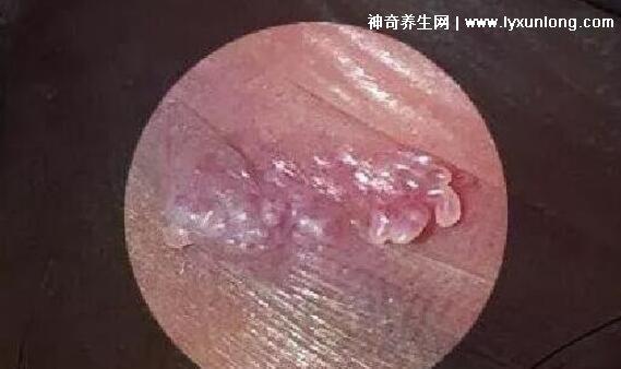 初期女士濕銳疣圖片早期，口腔尖銳濕癥狀太嚇人了(菜花樣疣體)