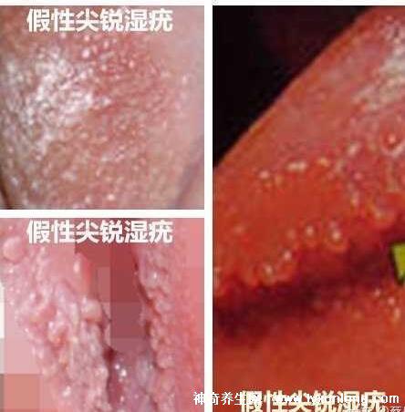 女性假疣和真疣的圖片對比，前者淡紅色和淡褐色魚子狀(5大區別)