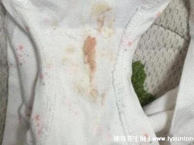 宮頸癌褐色分泌物圖片，少量不規(guī)則出血伴隨X交痛(腥臭分泌物)