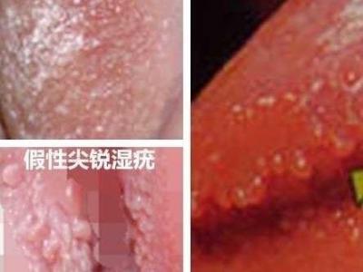 女性假疣和真疣的圖片對(duì)比，前者淡紅色和淡褐色魚子狀(5大區(qū)別)