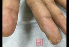 手指挫傷 做好幾點預防手指受傷