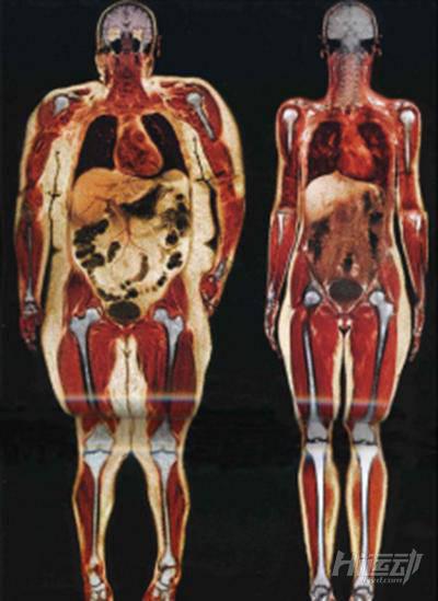 有研究表明肥胖能影響多種疾病，看完你還敢“胖”嗎？