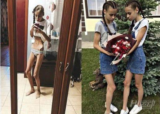 為成為模特這對雙胞胎做了這件事，患上厭食癥還成了“老奶奶”