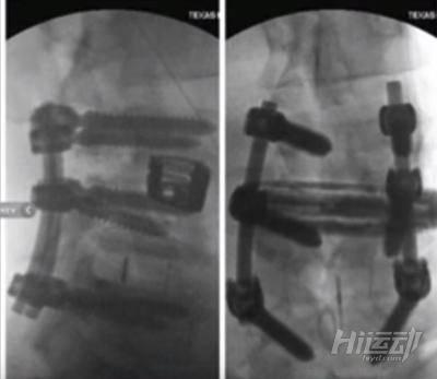 頭頂8個奧林匹亞冠軍，“祖師爺”身上已經打滿鋼釘！