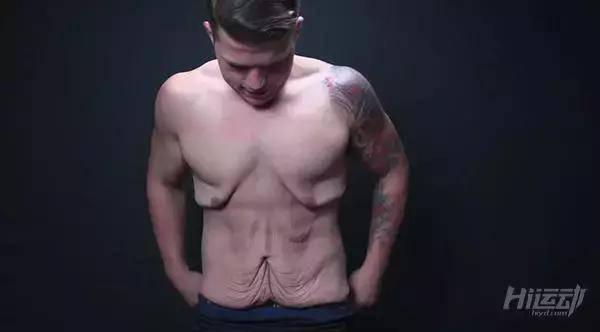 胖子成功減肥200斤，皮膚松弛也坦然面對！