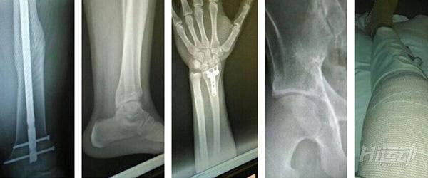 19歲小伙車禍后成殘廢！恢復性訓練重新站起來變型男