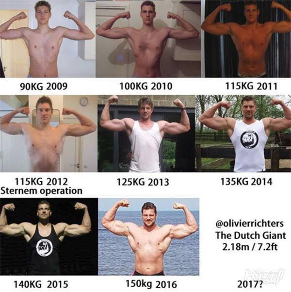 高個子健身本來就難！還因漏斗胸自斷10根肋骨治療