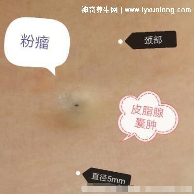 閉口粉刺真正的圖片，粗糙的顆粒會發炎長膿皰(黑頭也是粉刺)