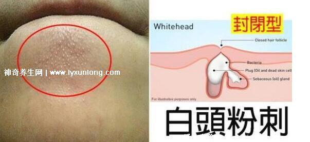 閉口粉刺真正的圖片，粗糙的顆粒會發炎長膿皰(黑頭也是粉刺)
