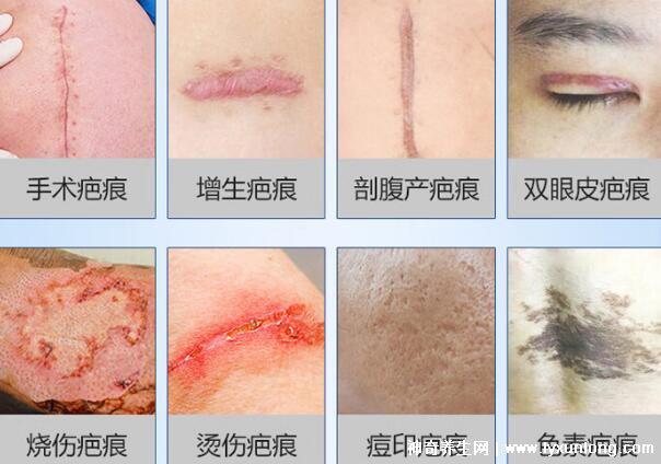 去疤痕最好的十大藥膏,疤克上榜強推康瑞保(3年內(nèi)的疤都能祛)-易網(wǎng)<a href=http://m.henggaotouzi.com/ target=_blank class=infotextkey>健康養(yǎng)生</a>網(wǎng) 去疤痕最好的十大藥膏,疤克上榜強推康瑞保(3年內(nèi)的疤都能祛)