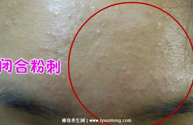 閉口粉刺真正的圖片，粗糙的顆粒會發炎長膿皰(黑頭也是粉刺)