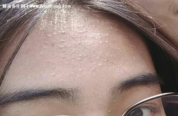 閉口粉刺真正的圖片，粗糙的顆粒會發炎長膿皰(黑頭也是粉刺)