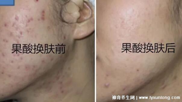 果酸換膚多少錢一次，1000-3000元不等(細(xì)致毛孔/淡化痘印)